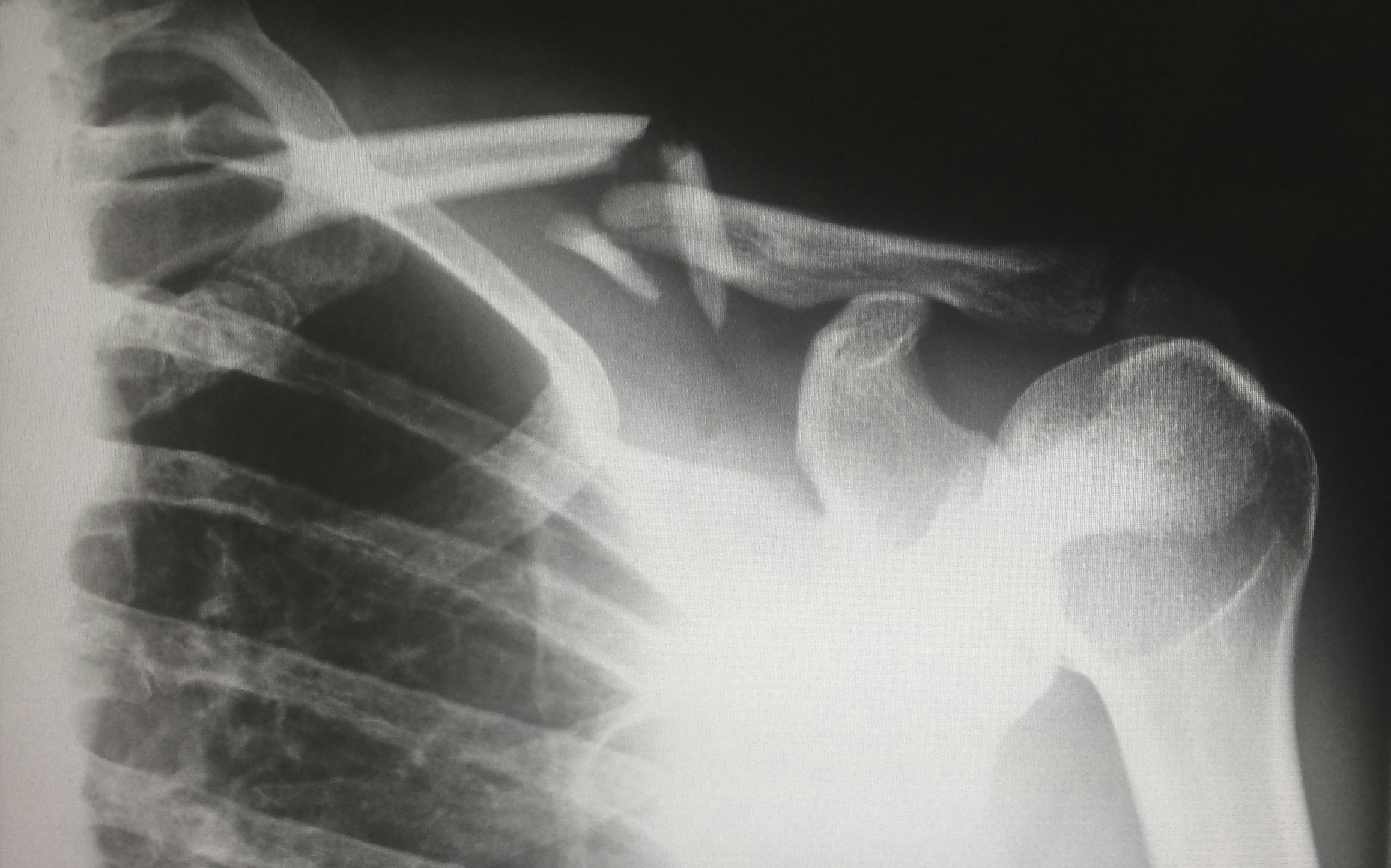 X-ray image showing a fractured clavicle near the shoulder joint