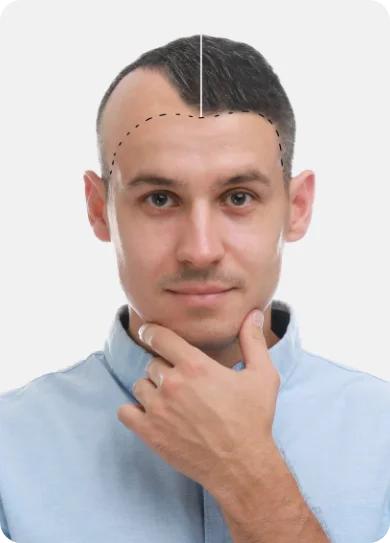 Man with receding hairline and dotted guideline showing possible hair restoration treatment, wearing a light blue shirt.