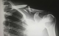 X-ray image showing a fractured clavicle near the shoulder joint